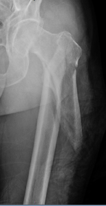 Pre-Surgery Fracture