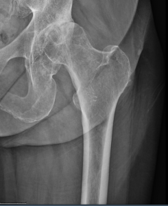 Ms. Smith's Hip Prior to Surgery