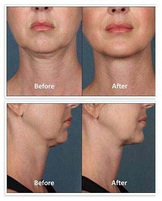 Goodbye, Double Chin–Without Surgery!