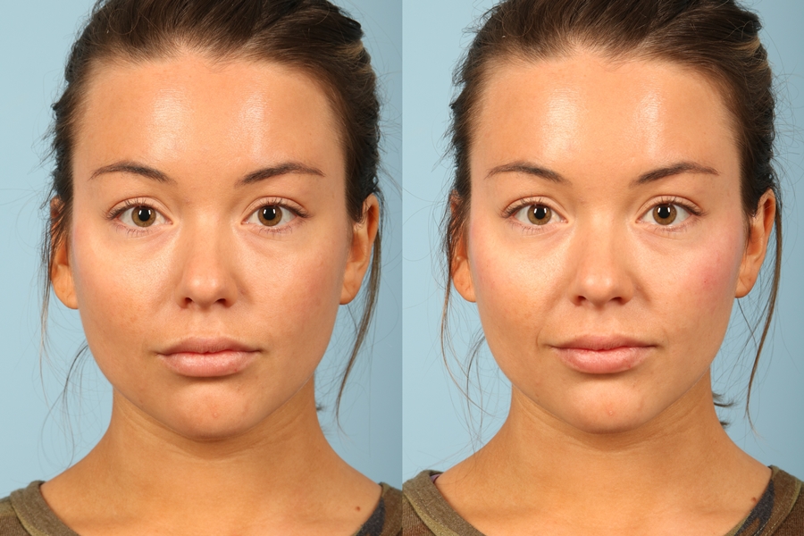 I forfremmelse udlejeren Contouring with Makeup or with Fillers? | Kavali Plastic Surgery and Skin  Renewal Center