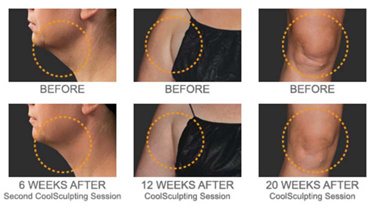 Freeze the Chin Fat  Kavali Plastic Surgery and Skin Renewal Center