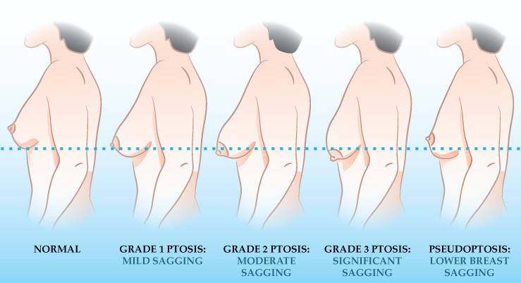 If I use a bigger implant, can I avoid a breast lift?