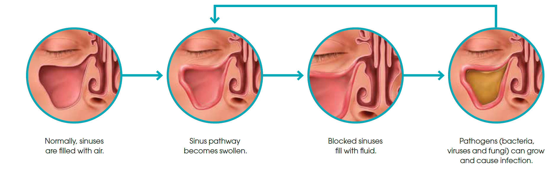 Dry sinus deals infection without mucus