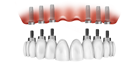 The Patient’s Guide To All-On-6 Dental Implants - | 1st Choice Dental Care