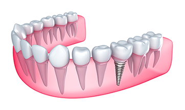 Dental Implant