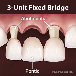 ATraditionalBridgeMightbetheRightSolutionforYourMissingTeeth