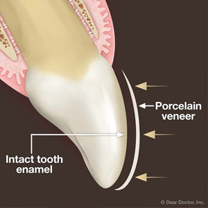 ANewVeneerwithMinimalorNoToothAlteration