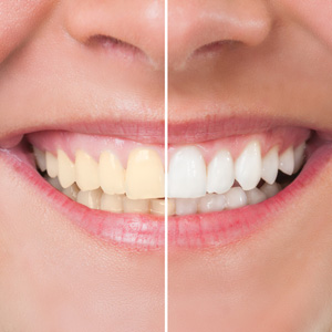 AnsweringYourQuestionsaboutYourUpcomingTeethWhitening