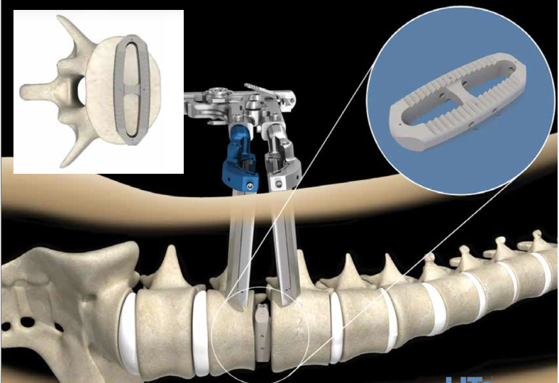 Extreme-Lateral Lumbar Interbody Fusion