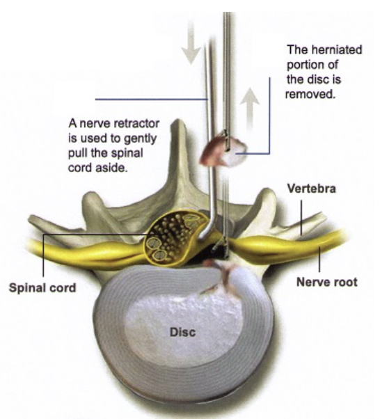 Lumbar Laminectomy