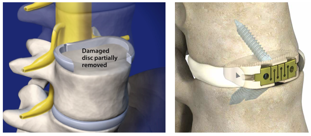 Anterior Lumbar Interbody Fusion