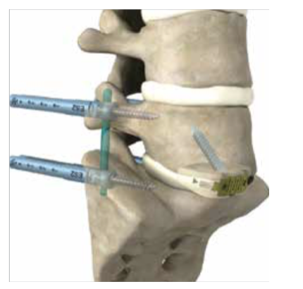 Anterior Lumbar Interbody Fusion | ALIF | Dr. Paul Jeffords, MD