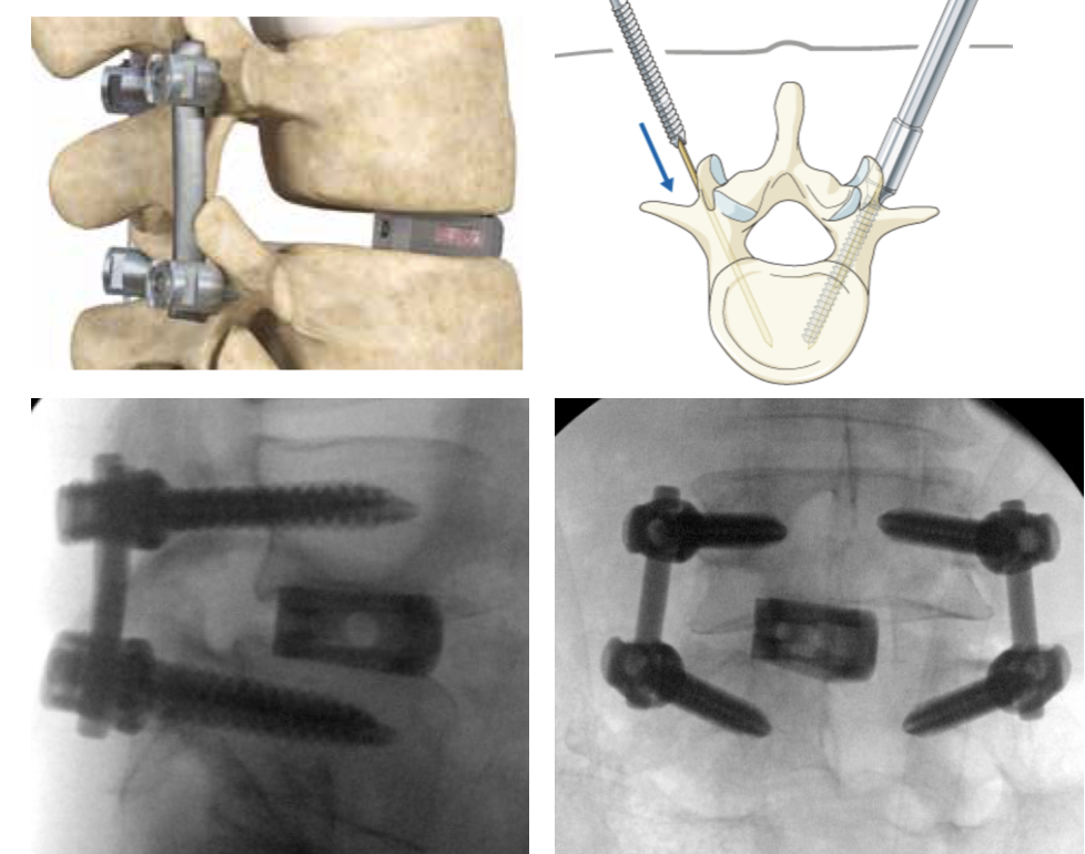 Minimally-Invasive Surgical (MIS) TLIF