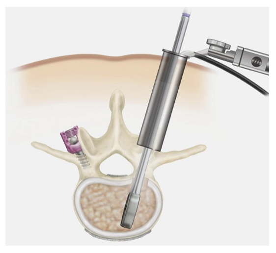 Minimally-Invasive Surgical (MIS) TLIF