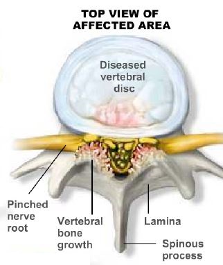 Lumbar Laminectomy