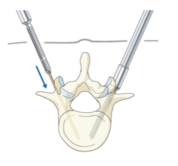 Extreme-Lateral Lumbar Interbody Fusion | XLIF | Dr. Paul Jeffords, MD