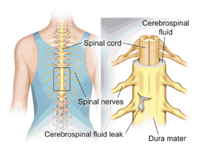 cerebrospinal fluid leak spine