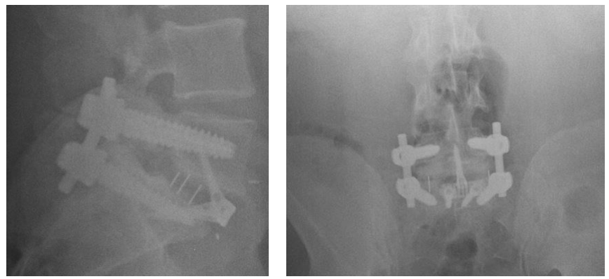 Anterior Lumbar Interbody Fusion