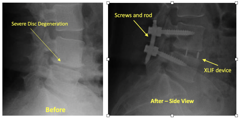 Extreme-Lateral Lumbar Interbody Fusion