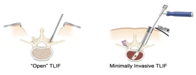 Minimally-Invasive Surgical (MIS) TLIF