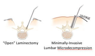 Minimally-Invasive Lumbar Microdecompression