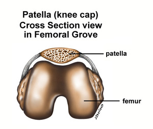 Patellofemoral Syndrome