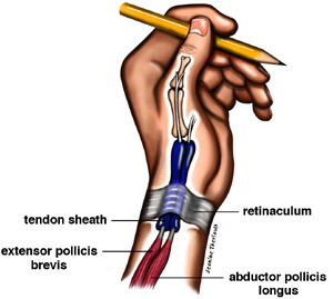 de Quervain-szindróma's Syndrome