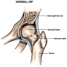 Total Hip Replacement