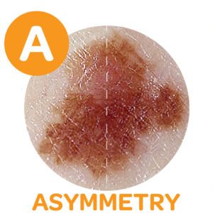 Abcde Melanoma Test Hand Out