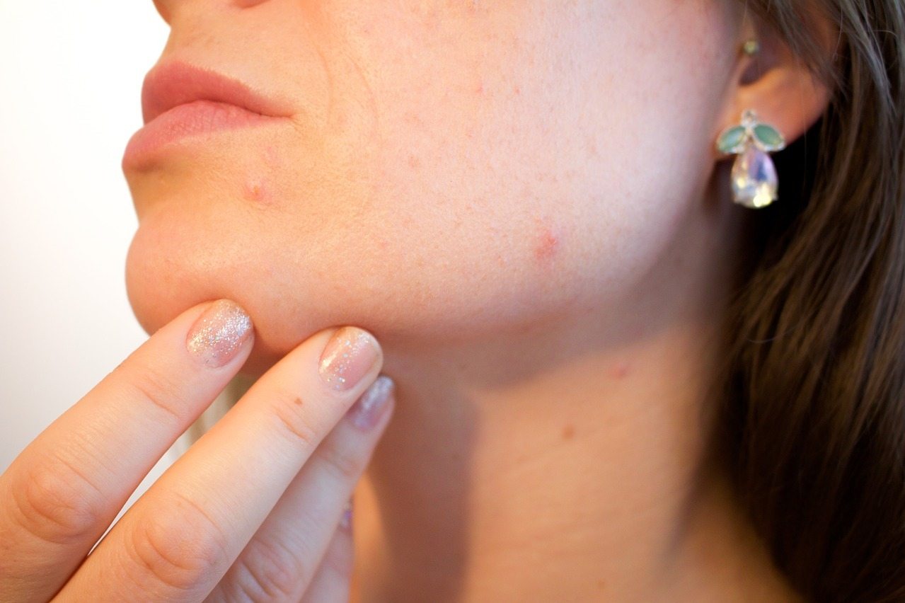 Adult acne often results from hormone imbalances.