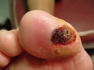 Diabetic foot ulcers are common. They don't hurt but they can be serious. Learn the facts and keep yourself healthy.