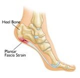 Plantar Fasciitis