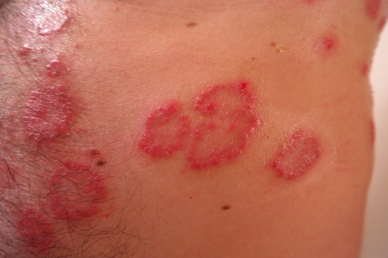 Psoriasis rash