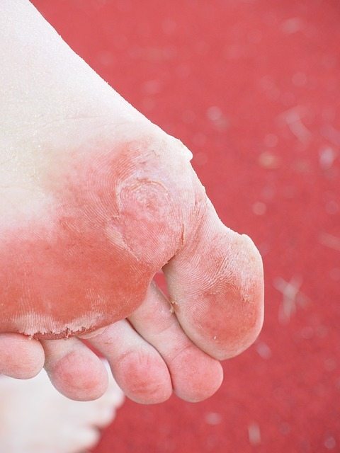 diabetic blisters on feet