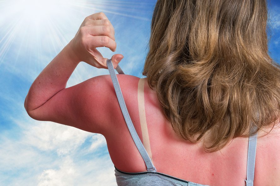 Sunburn concept. Young woman with red sunburned skin on her back.