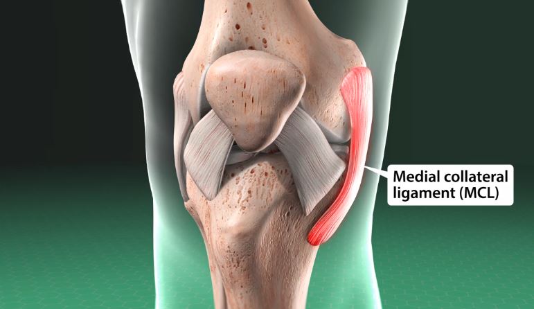 Medial Collateral Ligament (MCL) Sprain of the Knee