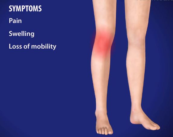 Patella tendonitis (jumpers knee) symptoms