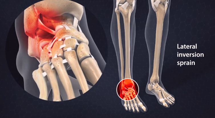 lateral inversion sprain